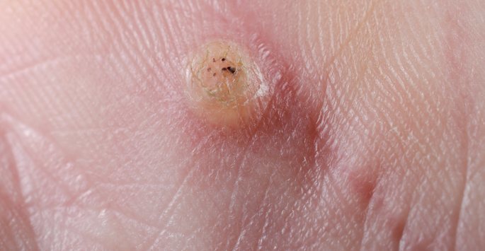 hpv warts spreading