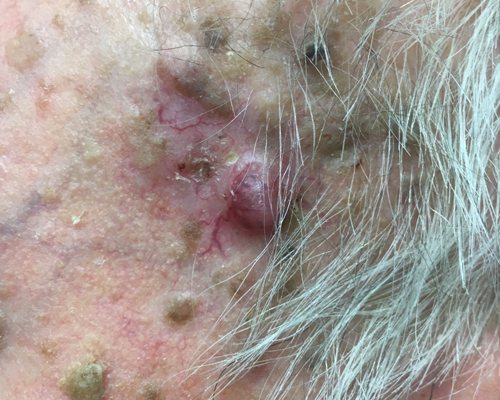 Basal Cell Carcinoma Treatment Cypress CA