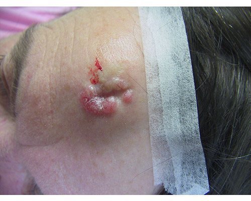 Basal Cell Carcinoma Treatment Westminster CA